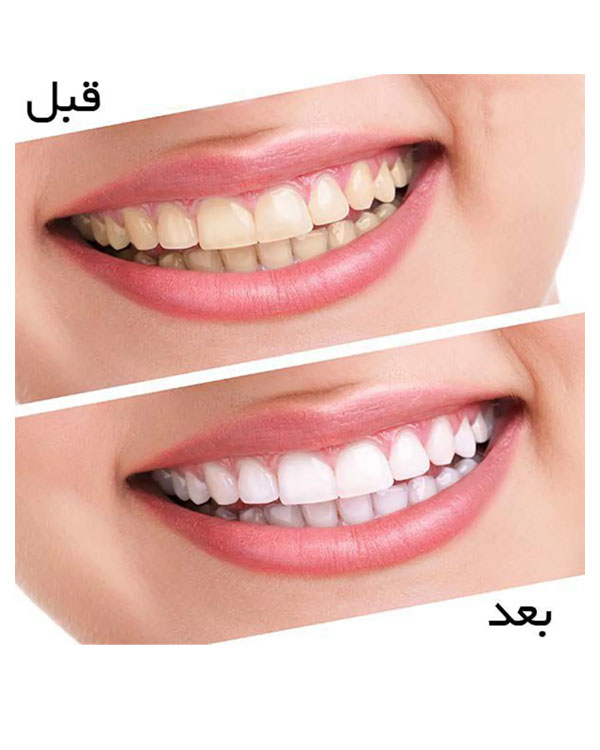  سفید کننده  دندان مدل light white